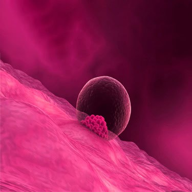 IUI –Intrauterine Insemination or Artificial Insemination (AI)